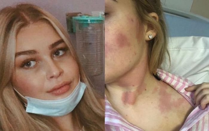 Bị khó nuốt, cô gái đi khám thì sốc khi biết mình mắc ung thư máu hiếm gặp