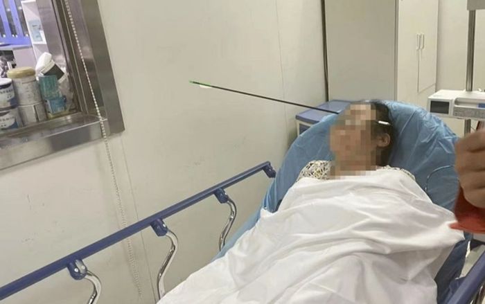 Đang đi bộ, người phụ nữ bị cung tên bắn xuyên qua mặt
