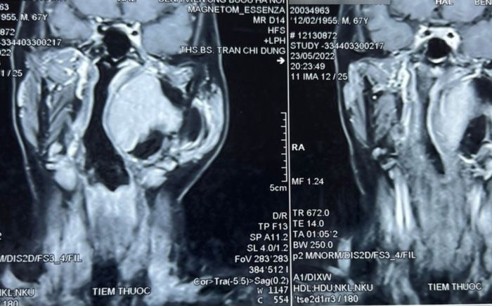 U khoảng bên họng phức tạp, hiếm gặp được phẫu thuật thành công