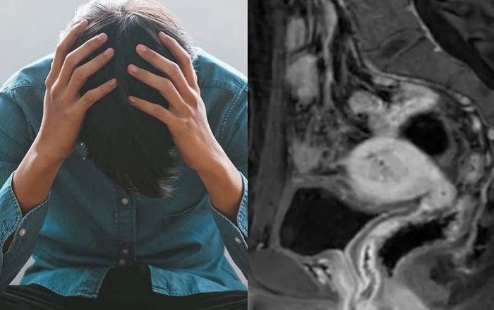 Người đàn ông bị sốc khi biết mình có buồng trứng, tử cung và kinh nguyệt hàng tháng