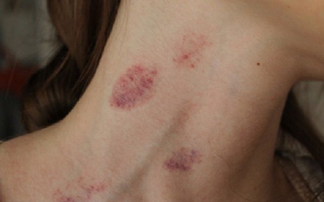 Cô gái 23 tuổi đột ngột qua đời sau khi hôn bạn trai