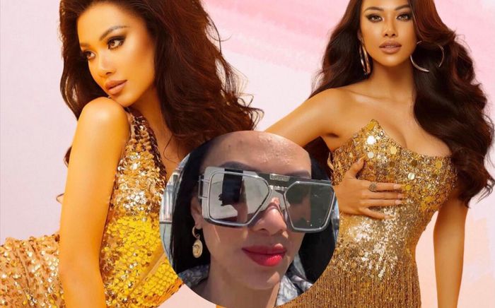 Kim Duyên khiến fan lo lắng khi để lộ gương mặt chi chít mụn
