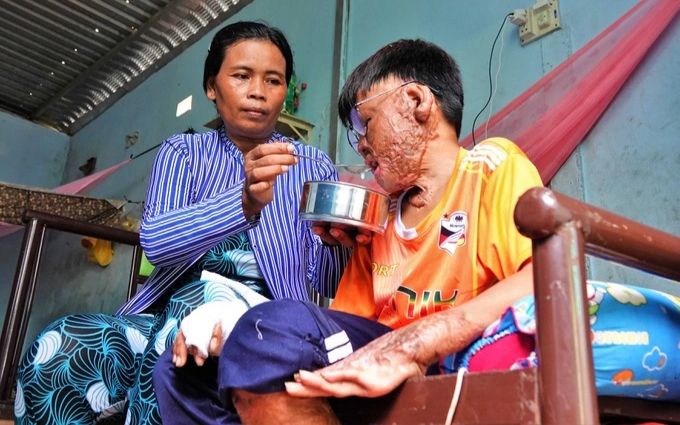 Liều mình cứu mẹ nuôi khỏi đám cháy, cậu bé bị biến dạng cơ thể, trải qua nhiều cuộc phẫu thuật đau đớn