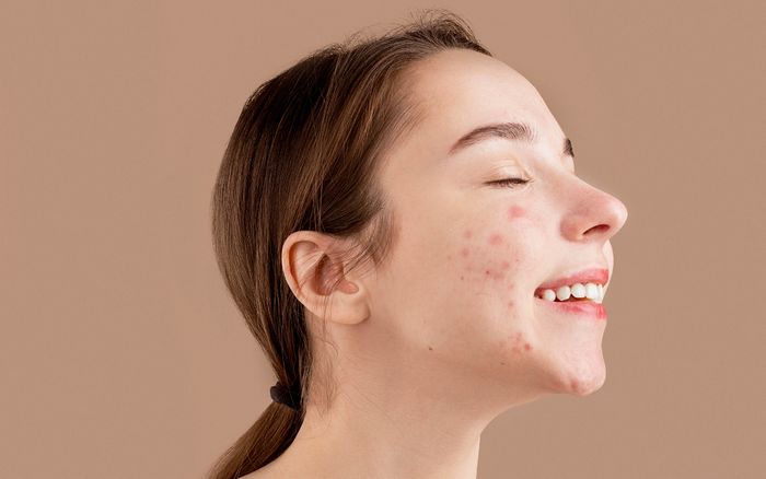 Bác sĩ da liễu mách nàng bí quyết xử lý sẹo mụn 'một lần và mãi mãi'