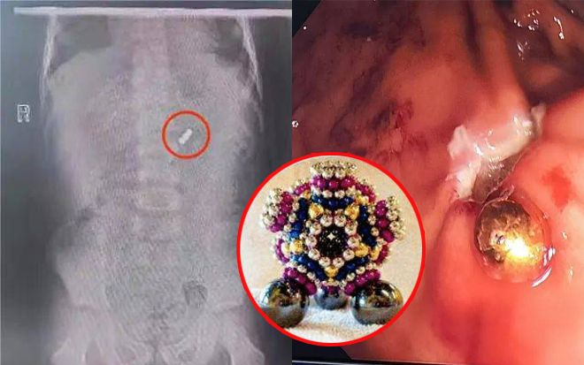 Biết con nuốt hạt từ tính đồ chơi, bố mẹ cố chấp không đưa đi viện và cái kết