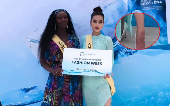 Đôi chân Đoàn Thiên Ân bầm tím, sưng vù khi dự sự kiện tại Indonesia