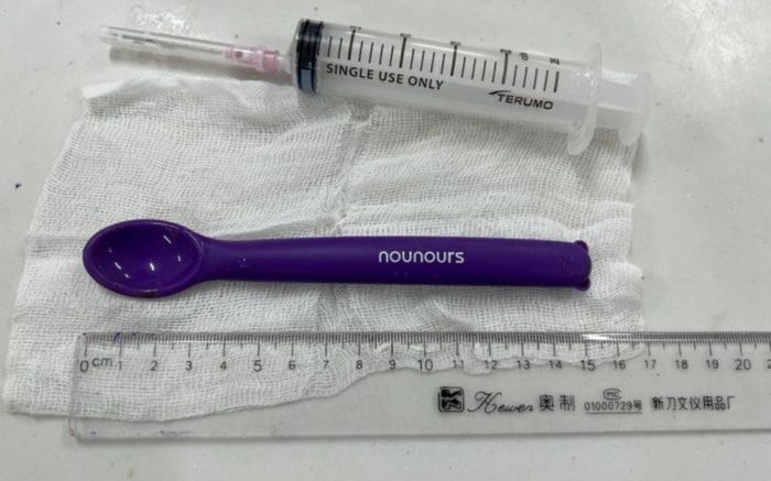 Cô gái say rượu rồi nuốt chiếc thìa nhựa dài 15cm vào bụng