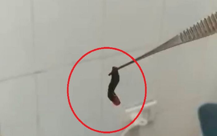 Đi khám vì thường xuyên chảy máu cam, tá hỏa phát hiện con vắt sống trong hốc mũi