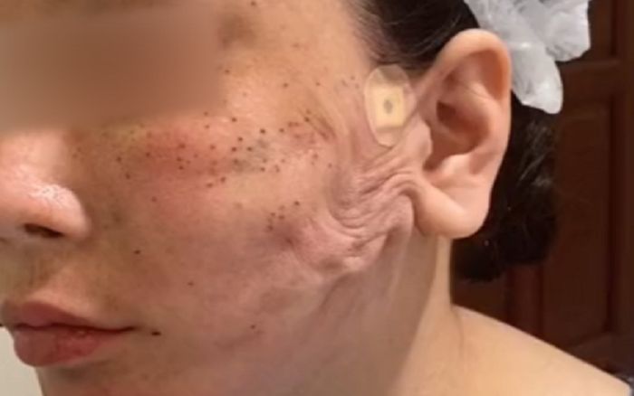 'Đàn giun' trên mặt người phụ nữ chỉ vì cách làm đẹp nhiều chị em thử