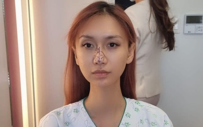 Không ưng ý ngoại hình sau nhiều lần phẫu thuật, Lynk Lee quyết tâm 'dao kéo' đến cùng