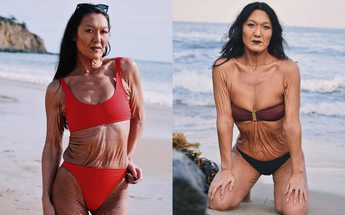 Mắc bệnh di truyền, người mẫu 31 tuổi có làn da nhăn nheo như bà lão