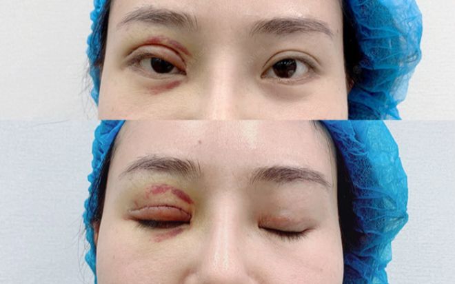 Hồi sinh đôi mắt biết cười với cô gái bị biến chứng hỏng 1 mắt phải sau cắt mí