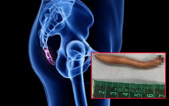 Em bé chào đời với chiếc đuôi dài 5,7cm ở mông