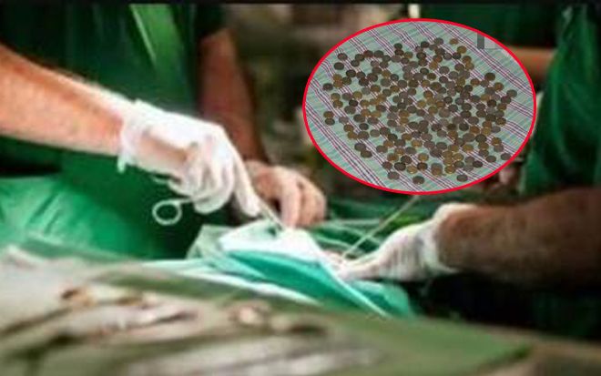 Bác sĩ chụp X-quang sốc nặng trước 'kho báu' trong bụng người đàn ông