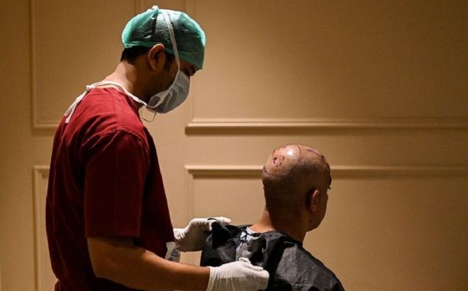 Người đàn ông hói đầu nhận kết cục bi thảm vì cố làm một điều để cưới vợ