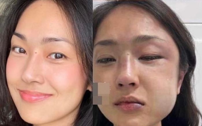Một MC nổi tiếng bị người yêu đánh sưng mặt trong ngày sinh nhật vì nghi ngờ bạn trai lăng nhăng