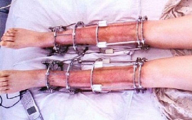 Khao khát có đôi chân dài, cô gái 19 tuổi trả giá đắt khi không thể đi lại được