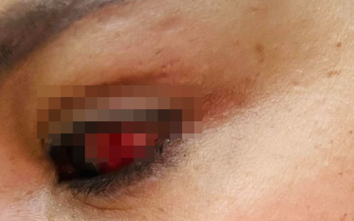 Một sao nữ Vbiz bị rách giác mạc nặng khiến nhiều khán giả lo lắng