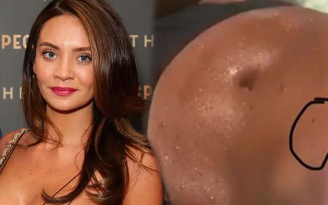 'Vô tư' với những đốm tàn nhang nhỏ trên bụng, người phụ nữ 'suy sụp' khi nghe bác sĩ thông báo