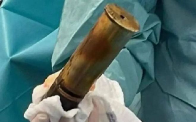 Đến cấp cứu với một quả đạn trong trực tràng, cụ ông 88 tuổi khiến cả bệnh viện kinh hãi sơ tán
