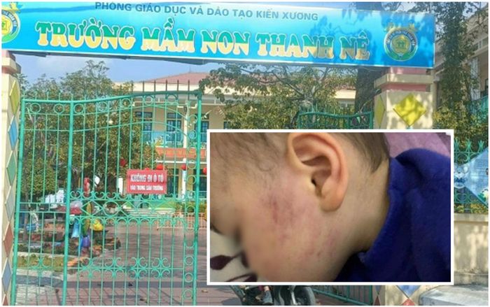 Phụ huynh phẫn nộ vụ bé trai 2 tuổi bị cô giáo mầm non tát bầm tím một bên má