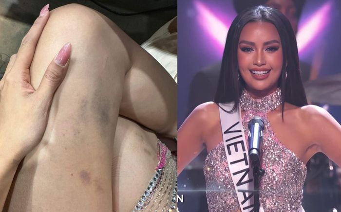 Ngọc Châu gây xúc động với đôi chân bầm tím sau chung kết Miss Universe: Đã cố hết sức rồi!