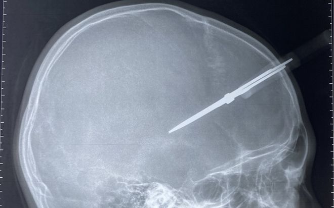 Trước ngày nghỉ Tết, bé trai bị kéo đâm thủng hộp sọ khi đang chơi đùa trong lớp