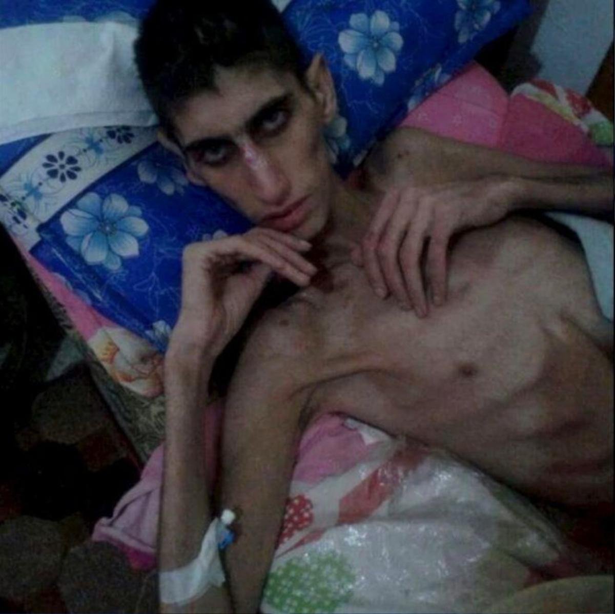 Một thanh niên ở Madaya gầy còm, ốm yếu vì đói. Ảnh: Reuters