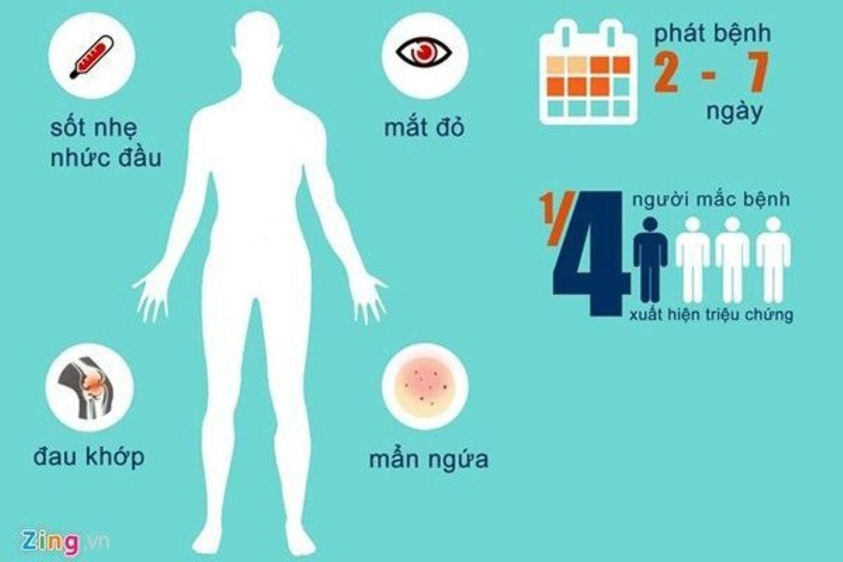 Triệu chứng của người nhiễm virus Zika.