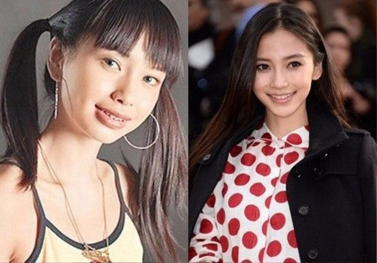 Mỹ nhân Hoa ngữ Angela Baby là một trong những ca điển hình của việc "lột xác nhờ niềng răng"