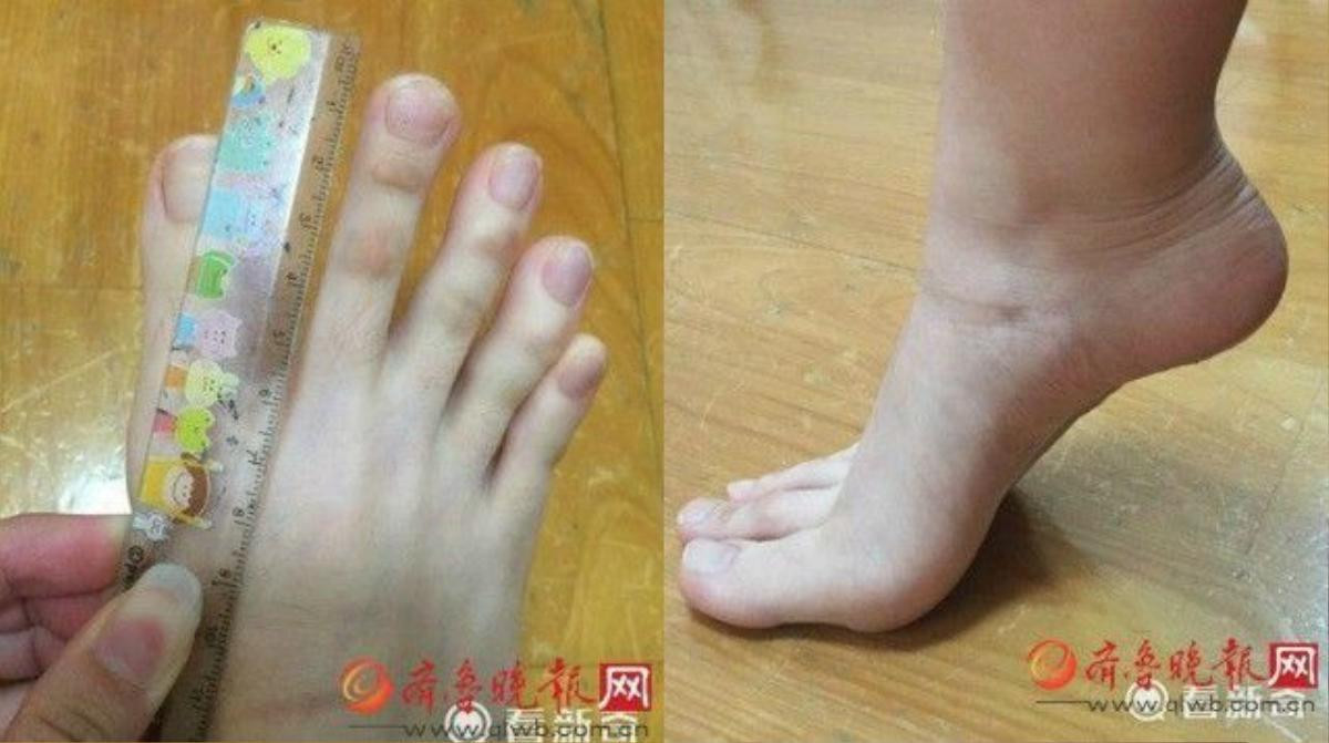 Ngón chân thứ hai của cô gái dài tới 5 cm