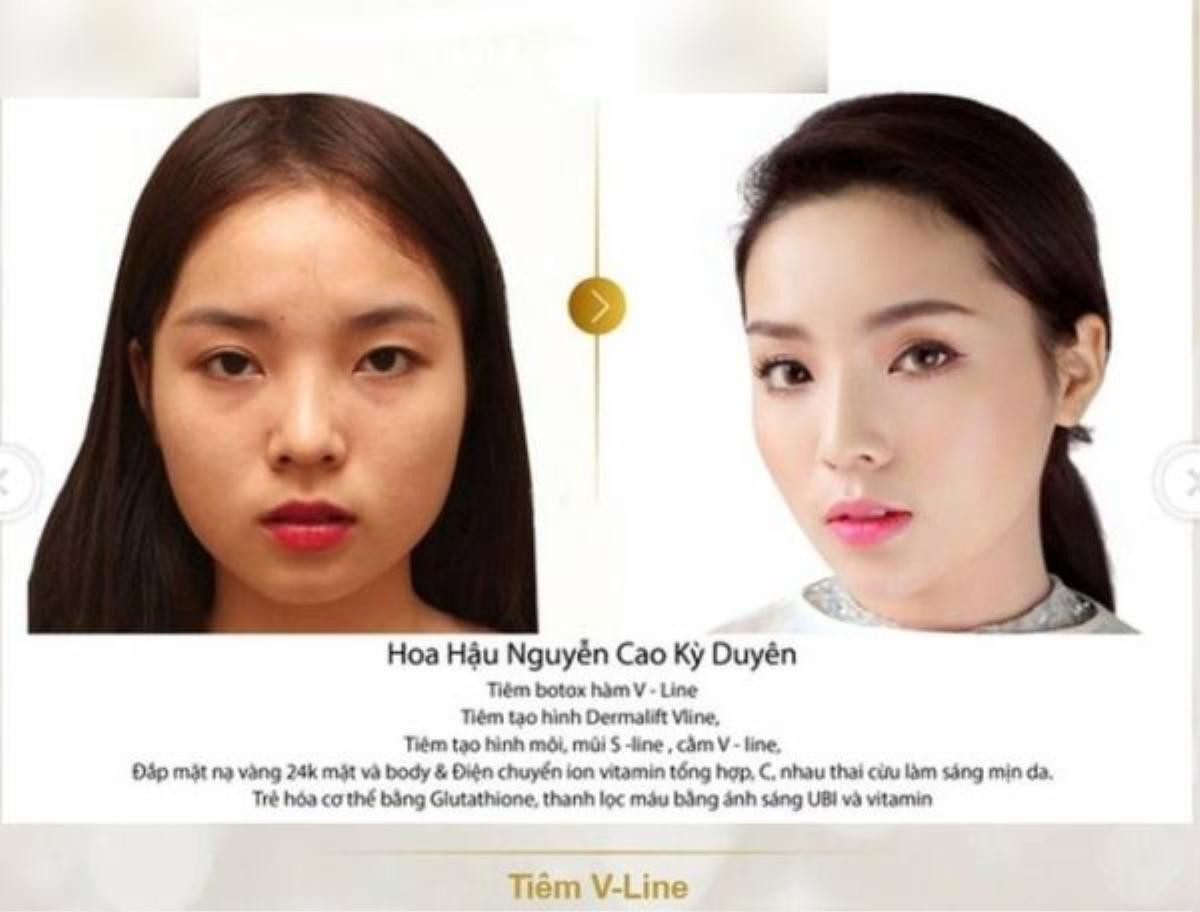 Hoa hậu Kì Duyên "mất điểm" vì tin đồn lạm dụng botox để làm đẹp.