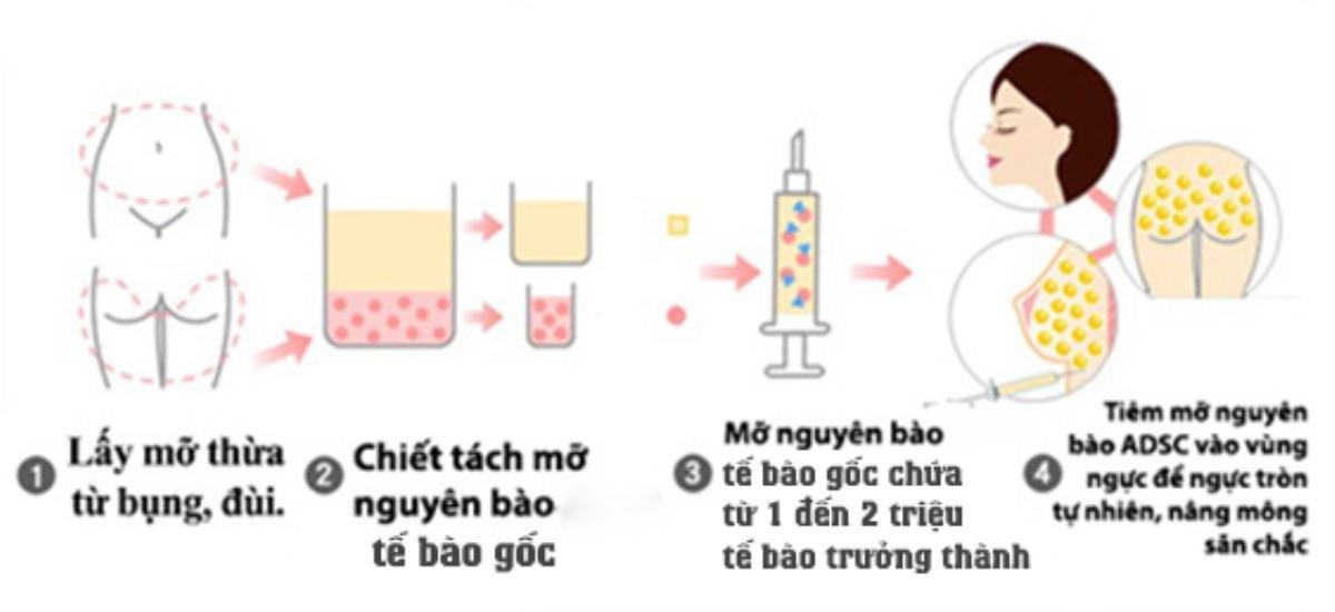 Thời tiêm filler đã qua rồi, giờ là mốt lấy mỡ tự thân cấy lên… mặt cơ! Ảnh 2