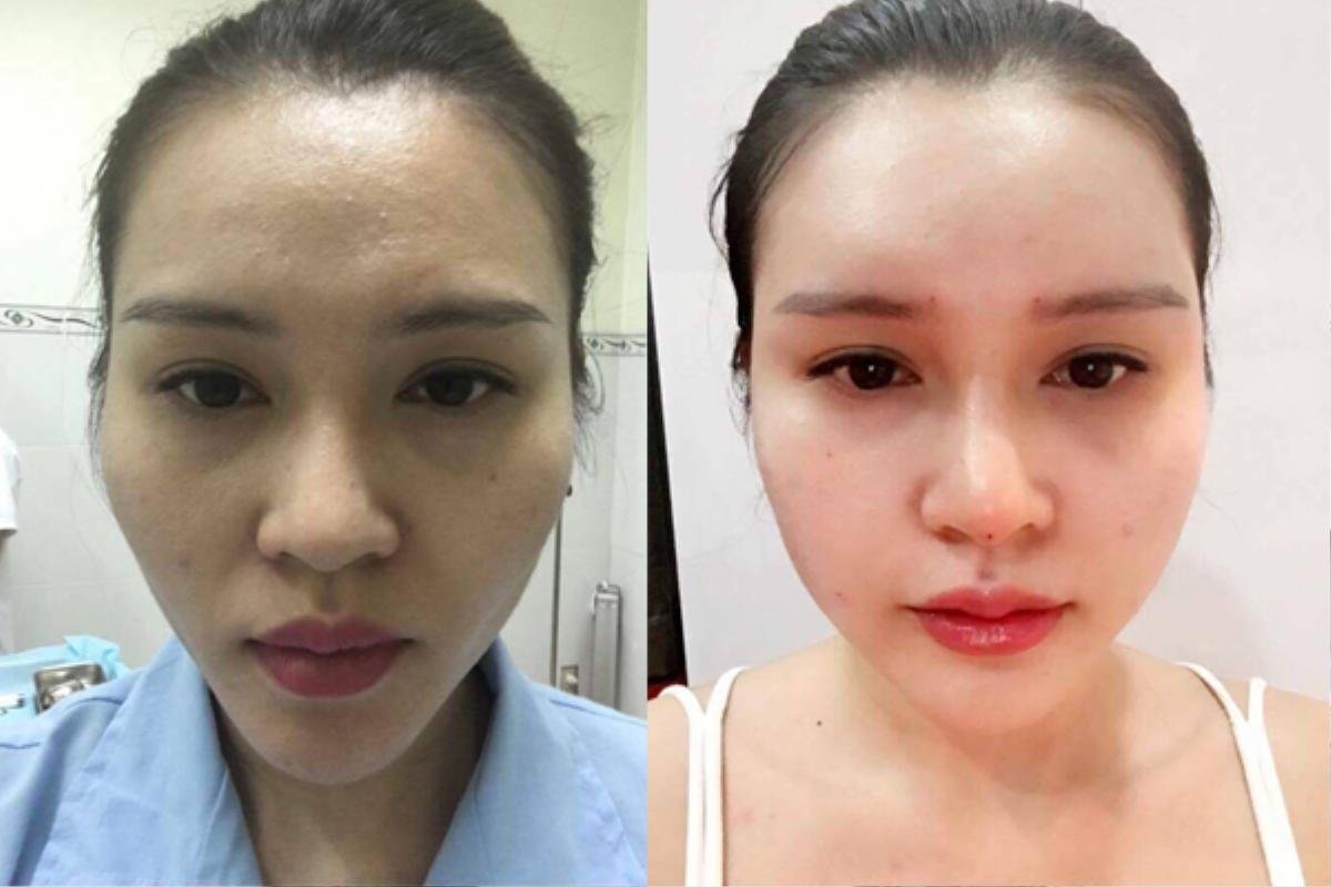 Thời tiêm filler đã qua rồi, giờ là mốt lấy mỡ tự thân cấy lên… mặt cơ! Ảnh 7