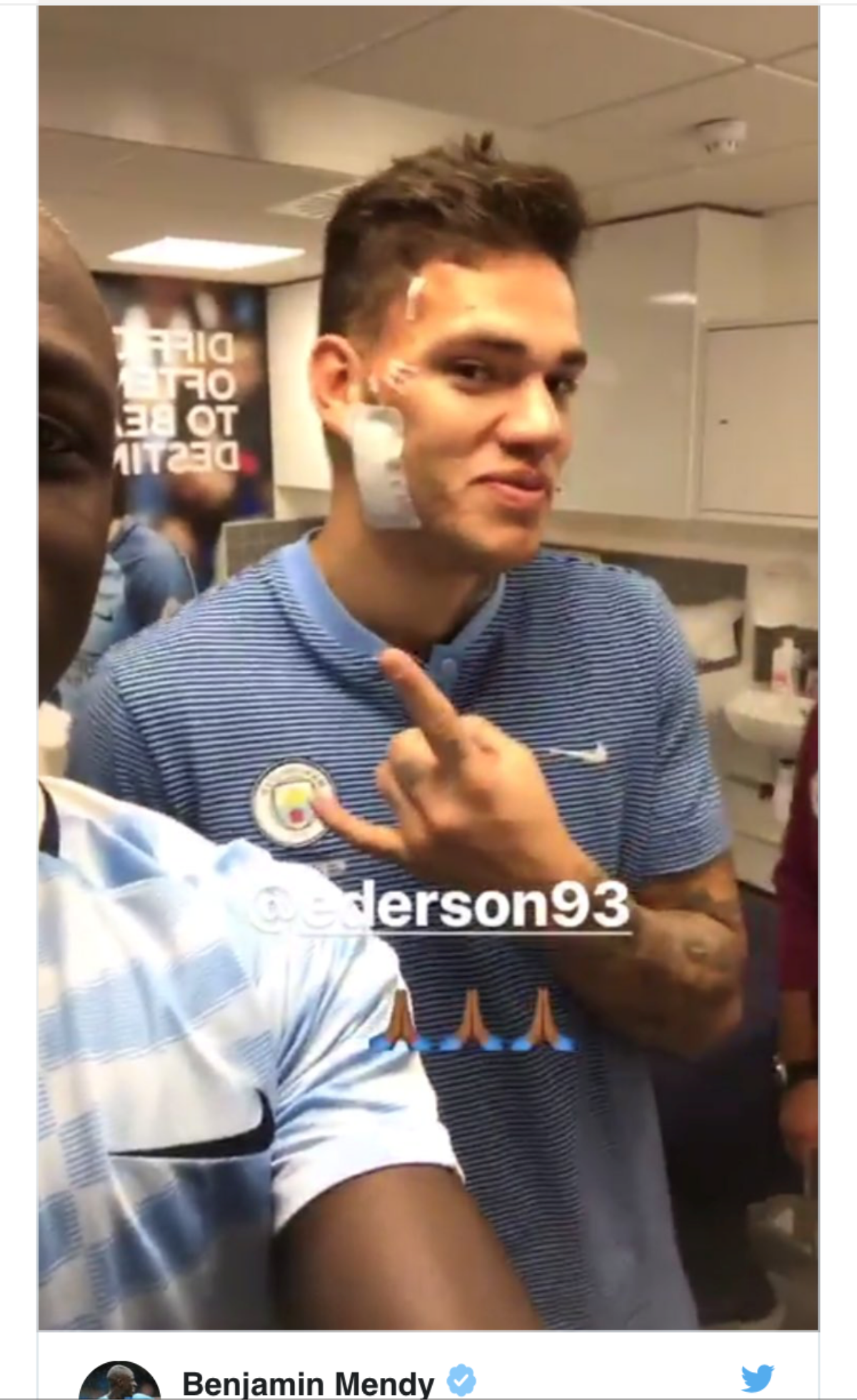 Thủ thành Ederson mặt 'chằng chịt' sẹo sau khi lĩnh cú đạp của Mane Ảnh 1