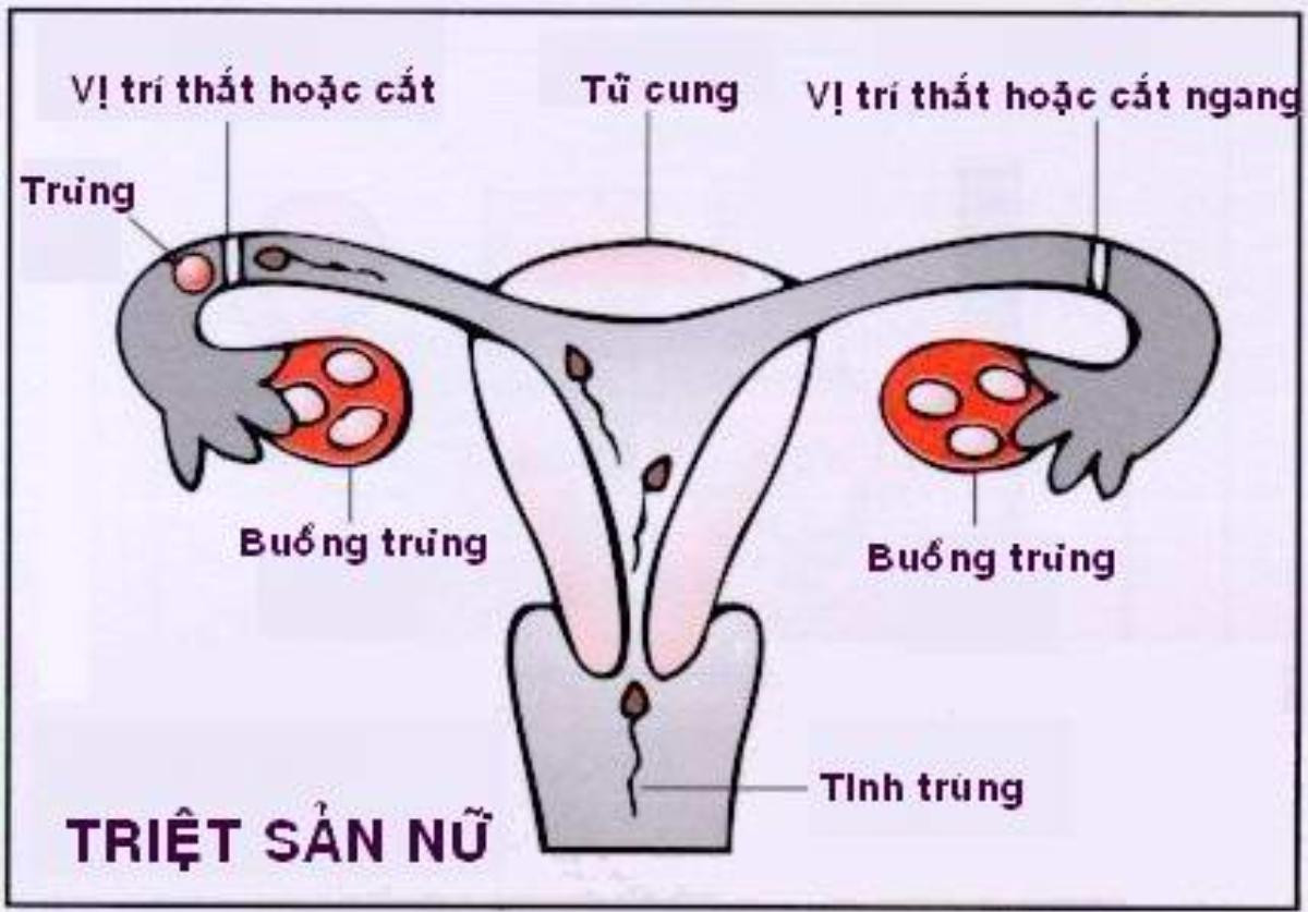 Bà mẹ 3 con hốt hoảng khi đã triệt sản nhưng vẫn mang thai Ảnh 2