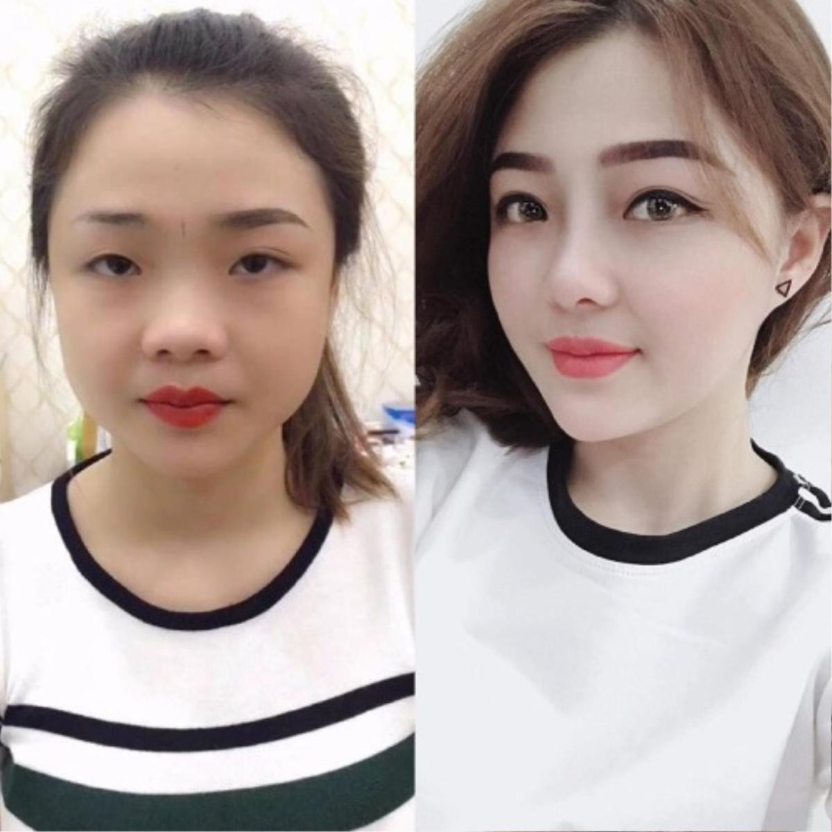 Cô gái mắt một mí 'đập mặt làm lại' trở nên xinh đẹp như hotgirl Ảnh 1