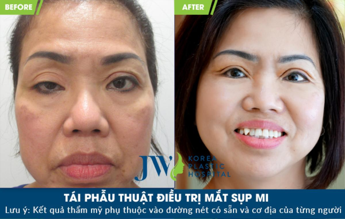 Nữ Việt kiều và câu chuyện tìm lại hy vọng cho đôi mắt sụp mí bẩm sinh Ảnh 3