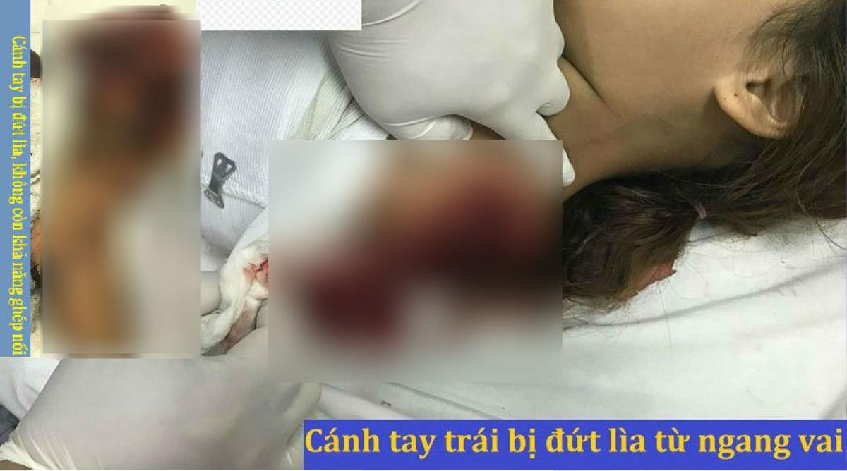 Chơi trốn tìm cùng bạn, bé gái bị máy cưa cắt đứt lìa cánh tay trái vĩnh viễn Ảnh 1