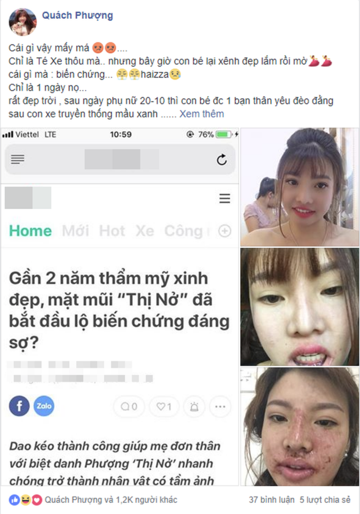 Bị đồn gương mặt biến dạng sau 2 năm PTTM, 'Thị Nở tái sinh' lên tiếng giải thích lí do khiến ai nấy đều ngã ngửa Ảnh 4