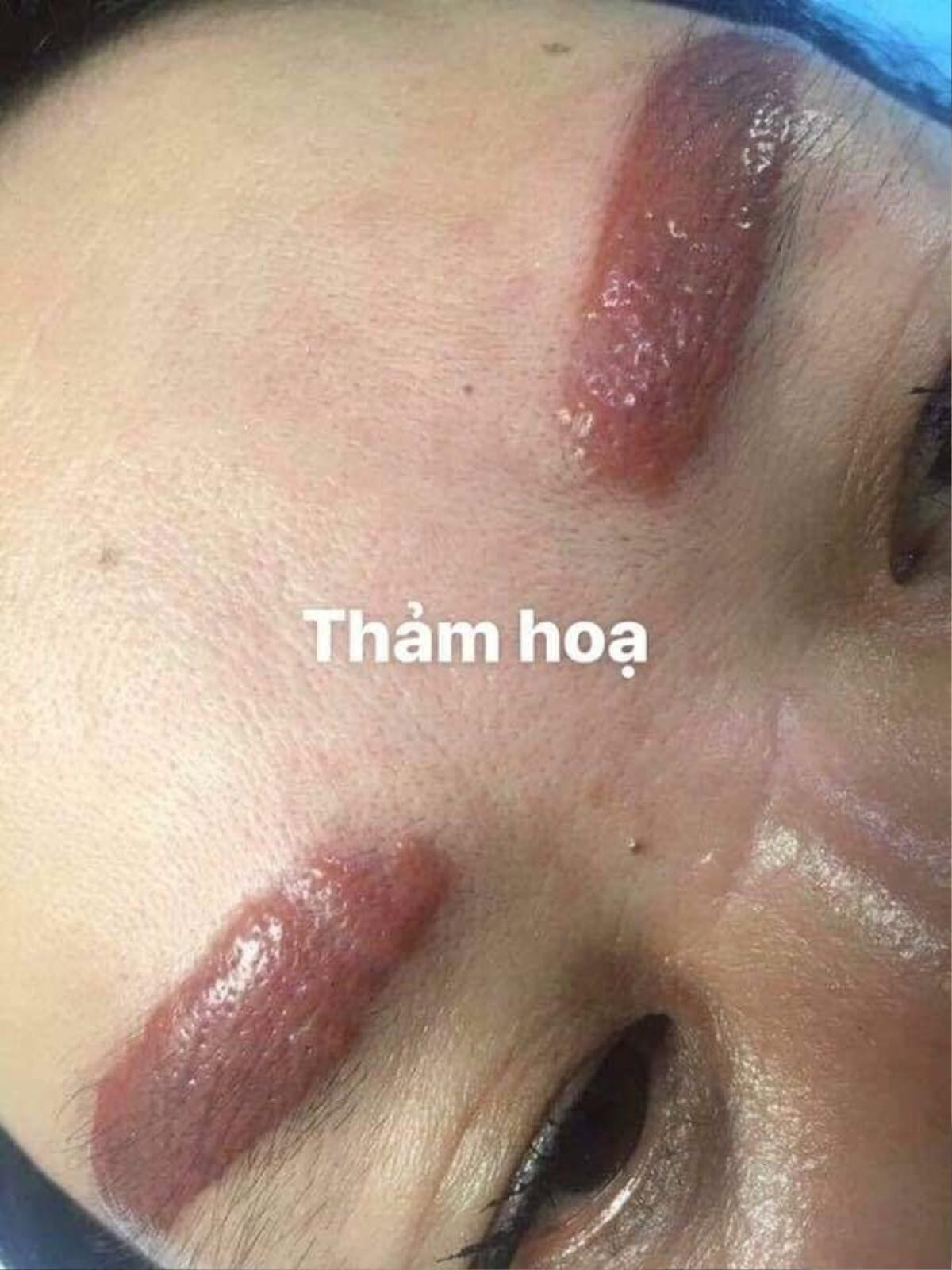 Ham rẻ, người phụ nữ rơi vào thảm họa xăm chân mày và để lại sẹo vĩnh viễn Ảnh 1