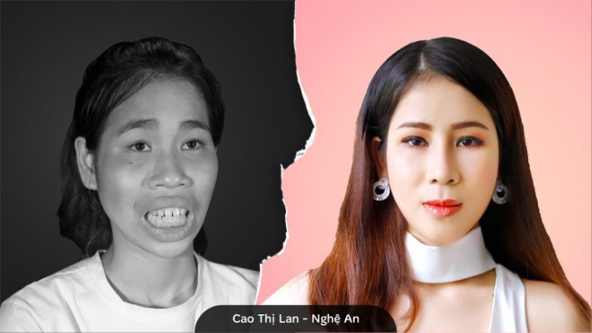 Cuộc sống mới của cô gái bị mẹ câm điếc xua đuổi sau phẫu thuật thẩm mỹ: 'Mình chưa nghĩ đến việc sẽ yêu ai đó” Ảnh 3