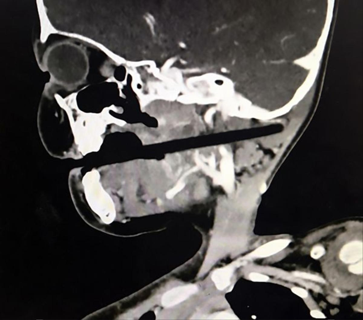 Đang chơi đùa, bé gái 3 tuổi bị đũa cắm vào họng, xuyên qua sọ 10 cm Ảnh 3