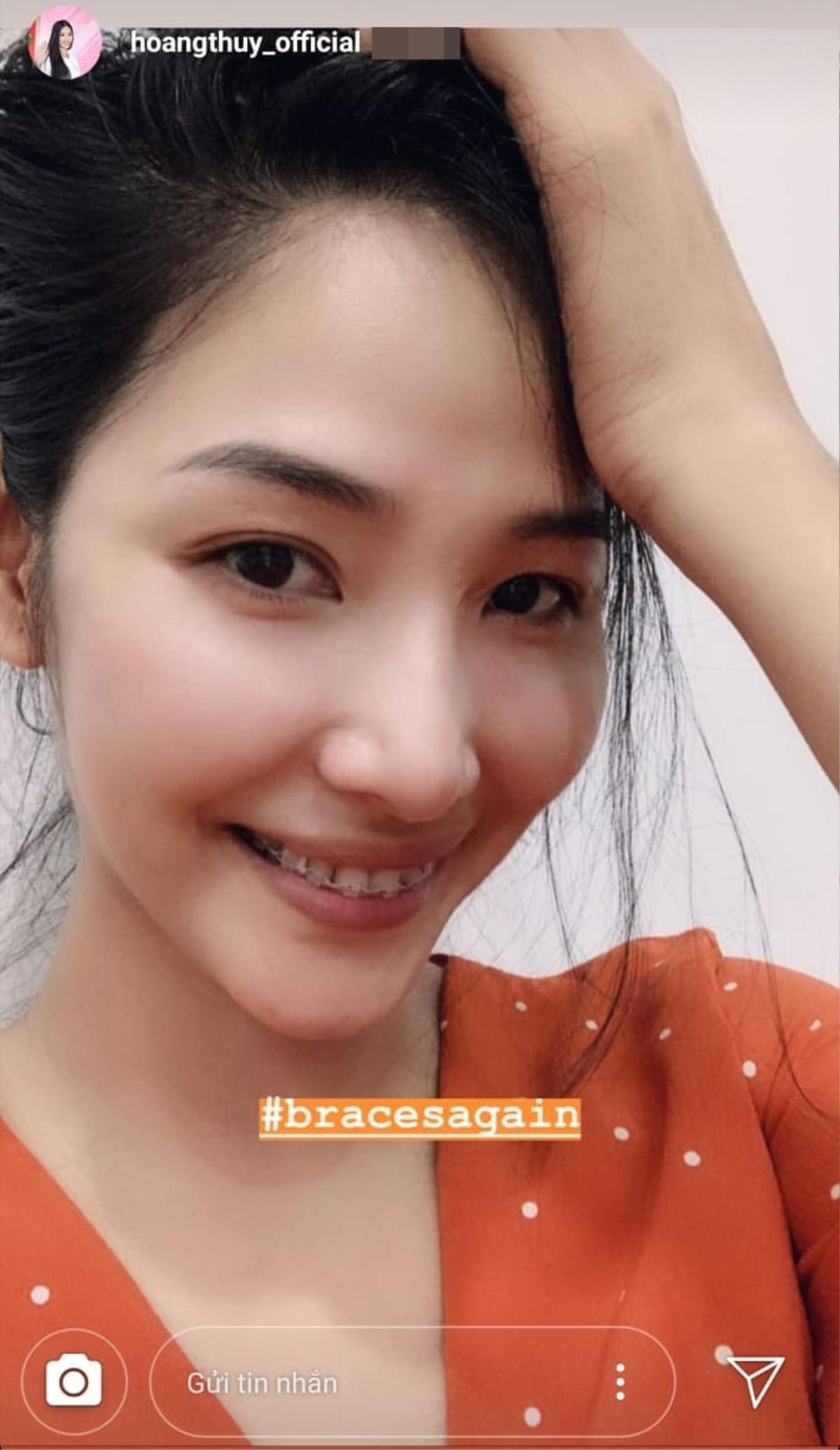 Fan chê cười xấu, Hoàng Thùy niềng răng 'cấp tốc' chuẩn bị chinh chiến Miss Universe 2019 Ảnh 1