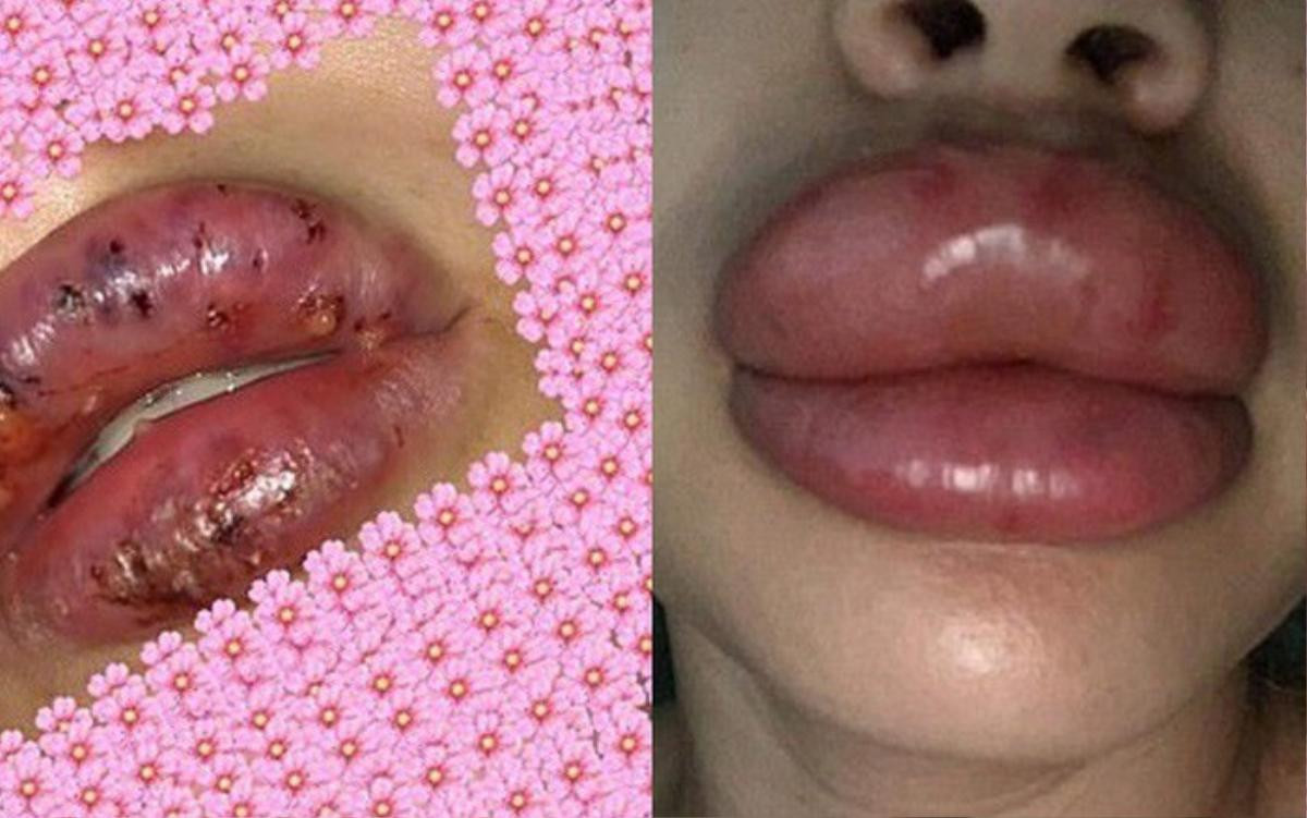 Những đôi môi sưng 'siêu to, khổng lồ' vì tiêm filler giá rẻ, coi xong sợ đến già Ảnh 3