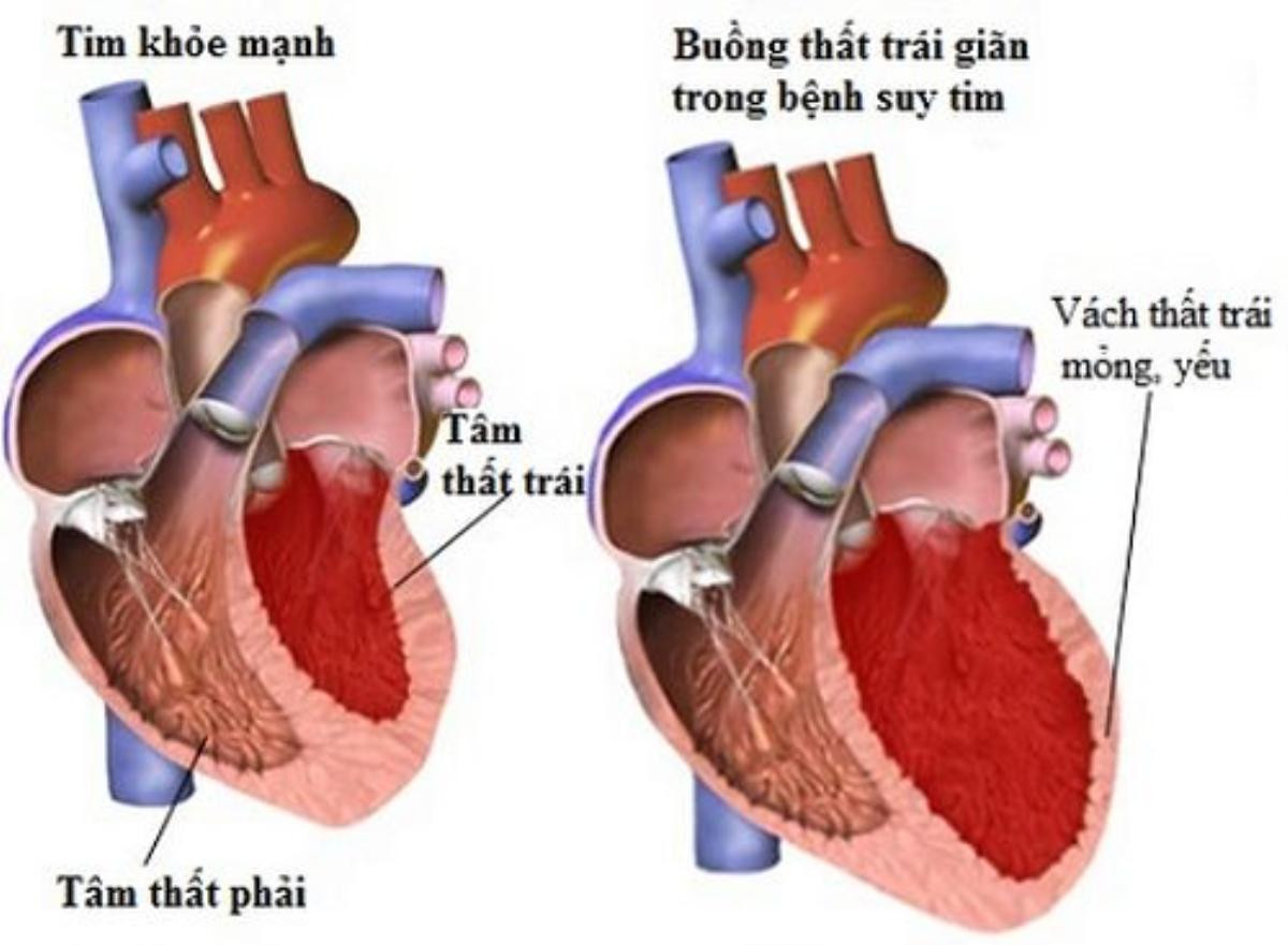 Biến chứng nhồi máu cơ tim khiến NSND Thế Anh đột ngột qua đời nguy hiểm ra sao? Ảnh 2