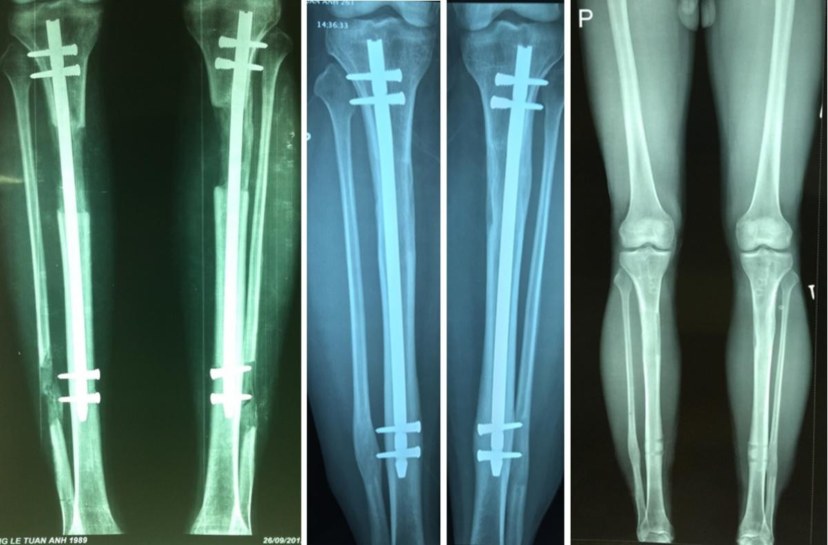 Tin vui cho những người tự ti với chiều cao có hạn khi có thể kéo dài chân thêm 16cm Ảnh 2