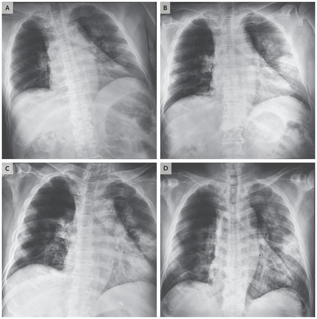 Bác sĩ Bệnh viện Chợ Rẫy điều trị khỏi cho bệnh nhân nhiễm virus corona như thế nào? Ảnh 2