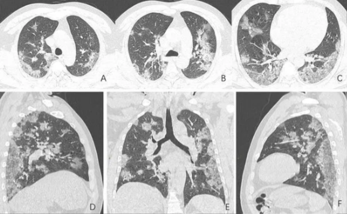 Sự tàn phá nặng nề của COVID-19 gây ra trên phổi bệnh nhân Ảnh 2