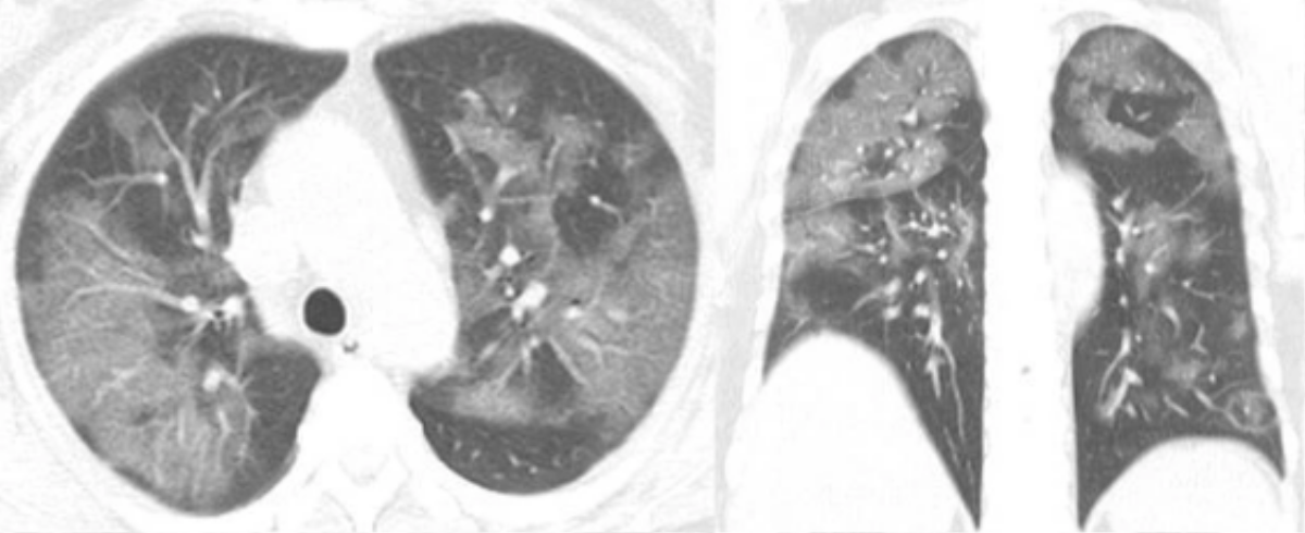 Sự tàn phá nặng nề của COVID-19 gây ra trên phổi bệnh nhân Ảnh 3